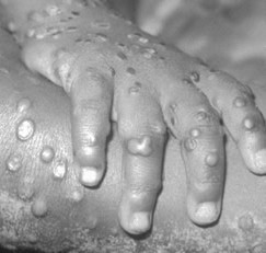Doctors can distinguish monkeypox from other diseases through different symptoms, but one of the primary ways to notice it. Monkeypox Symptoms : afrol News - Cousin of smallpox virus spreading in DR Congo